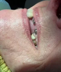 Dental Implant Case 10 Before