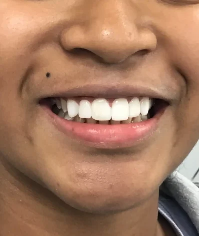 Dental Veneers After