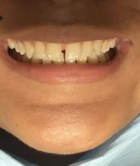Dental Veneers Before